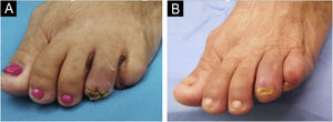 (A) 30-days postoperative: presence of crusts and scaling. (B) 90-days postoperative: complete healing with apparent recovery of the nail plate.