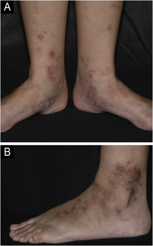 Livedoid vasculopathy. (A) Active lesions characterized by small ulcers with crusts and erythematous-purpuric edges located on the medial side of the legs and feet. Livedo racemosa is also noted on the dorsum of the feet; (B) Lesions in remission on the lateral side of the leg and foot with brownish scars and ivory-white stellate scars characterizing Millian