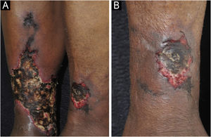 Calciphylaxis: (A) Retiform purpura and advanced stage of necrotic ulcers in the classical reticulated format in the lower limbs. (B) Close-up of the necrotic ulcer (patient of Ref. 39).