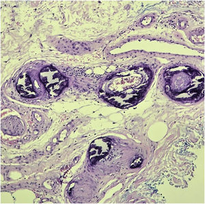 Histopathology of calciphylaxis lesion. Necrosis of subcutaneous fat, with significant calcium deposition on the vessel wall and intima proliferation (Hematoxylin & Eosin, ×400).