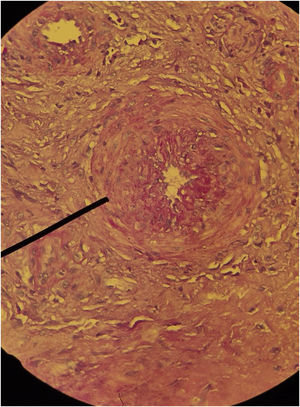 Histopathology of hypertensive ischemic ulcer. Concentric hypertrophy of the tunica media of an arteriole in the deep dermis (Hematoxylin & eosin, ×400).