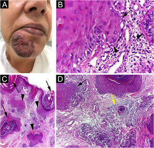 (A) Solitary verrucous infiltrated plaque with erythematous border and hyperchromic and a little violaceous color in the center; (B) The epidermis shows basal cell damage (arrows), thickening of the basal membrane (arrowheads) (Hematoxylin & eosin, ×40); (C) The epidermis shows hyperkeratosis (arrows). The dermis shows infundibular epithelium hyperplasia (arrowheads) and dermal inflammatory infiltrate (Hematoxylin & eosin, ×400); (D) The epidermis shows basal cell damage (arrows) and dermis shows mucin deposition (yellow arrows) (Hematoxylin & eosin, ×400).