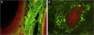 (A) Direct immunofluorescence (×400) showed junctional IgG coarse granular deposits; (B) IgM adsorption in colloid bodies.