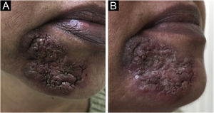 (A) Despite the treatment, after 6 months, the lesion had progressed to involve the labiomental sulcus; (B) After 21 months, minimal lesion remission could be achieved.