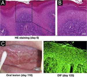 Clinical and pathological features of this patient. (A) Histopathological features for the biopsy of the right margin of tongue with white patch (Hematoxylin & eosin staining, scar bar=50μm). (B) Oral lesions. (C) Direct Immunofluorescence (DIF) showed positive intercellular staining of IgG.