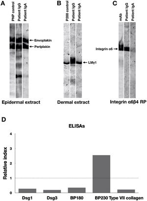 Immunoblotting and ELISA results of this patient serum. (A) Immunoblotting of epidermal extract showed positive IgG and IgA autoantibodies against both envoplakin and periplakin. (B) Immunoblotting of dermal extract showed positive IgG and IgA autoantibodies against Laminin (LM) γ1. (C) Immunoblotting of integrin α6β4 Recombinant Protein (RP) showed positive IgG autoantibodies against integrin α6. The integrin α6β4 RP was purchased from R&D systems (Minneapolis, MN, USA). mAb, a monoclonal antibody to integrin α6 (Beyotime, Shanghai, China). (D) Detection of IgG autoantibodies against Desmoglein (Dsg) 1, Dsg3, BP180, BP230 and type VII collagen by ELISAs using a commercially available kit (MBL, Japan). Only anti-BP230 autoantibodies were found to be positive. Dot lines indicate the cutoff value.