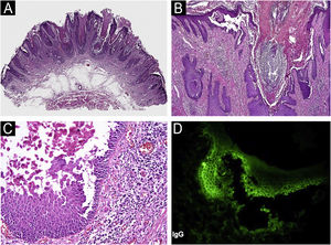 (A&#¿;C) Light microscopy of the first biopsy reveals epidermal hyperplasia, papillomatosis, and acantholysis. (D) Direct Immunofluorescence demonstrates intercellular deposition of IgG.