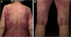 (A) Suberythrodermic rash on back. (B) Suberythrodermic rash on posterior aspect of legs.