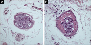 Emboli of atypical epithelioid cells on the skin (A and B, Hematoxylin-Eosin, 400×).