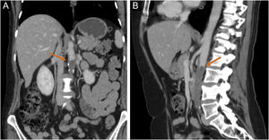 Computed tomography showing complete occlusion of the descending abdominal aorta (arrows). Coronal (A) and sagittal (B) scans.