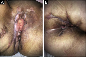 Complete healing of skin ulcers and livedoid lesions on the vulvar (A) and perianal (B) areas.