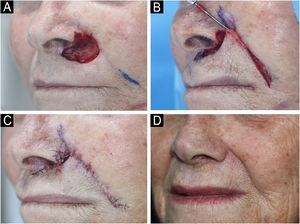 (A) Surgical defect after 3 stages of MMS involving multiple subunits: nasal ala, apical triangle and upper cutaneous lip. (B) Rotation flap movement. (C) Immediate postoperative. Upper cutaneous lip and apical triangle were restored with a nasolabial rotation flap whereas the nasal ala was restored with a full-thickness skin graft. A small area was left to heal by second intention to help recreate the concavity between the nose and the apical triangle. (D) Two months postoperative.