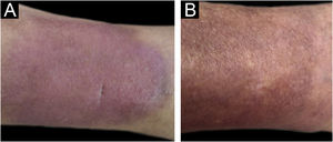 (A) Erythematous infiltrated plaque on the left leg. (B) Appearance after treatment, with residual hyperpigmentation.