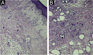 Histopathology: (A) Diffuse inflammatory infiltrate with edema in the upper dermis (Hematoxylin & eosin, ×100). (B) The infiltrate extends to the dermal-hypodermal junction (Hematoxylin & eosin, ×200).