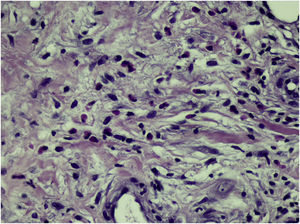 Histopathology: high magnification showing numerous eosinophils (Hematoxylin & eosin, ×400).