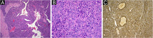 (A) At low magnification, neoplasm consists of round cells around vascular spaces (Hematoxylin & eosin, ×40). (B) Higher magnification shows atypical glomus cells with pleomorphic nuclei and prominent nucleoli. Numerous mitotic figures are seen (Hematoxylin & eosin, ×200). (C) Tumor cells are positive for actin (Anti-Smooth Muscle Actin, ×100).