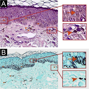 Light microscopy of a hyperpigmented patch on the cheek revealed increased melanin pigmentation of basal cells in the epidermis (arrows) and some melanophages in the superficial dermis (arrowheads). (A) Hematoxylin & eosin, 100×; (B) Fontana Masson, 100×.