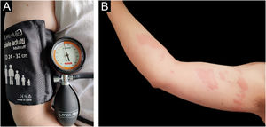 (A) Provocation test performed using a forearm sling with a pressure of 20.7 kPa for 15 min. (B) Patient’s right arm, 4 hours after provocation test using a forearm sling with a pressure of 20.7 kPa for 15 min during therapy with Cetirizine at a four-fold daily dose. The patient reported multiple diffuse skin swelling associated with nausea and chills.