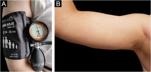 (A) Provocation test performed using a forearm sling with a pressure of 20.7 kPa for 15 min. (B) Patient’s right arm, 4 hours after provocation test using a forearm sling with a pressure of 20.7 kPa for 15 min after 3 administrations of Omalizumab 300 mg every 4 weeks. Negative for skin lesions and systemic symptoms.