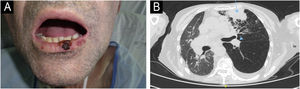 Patient Number 1. In Patient 1, a cutaneous squamous cell carcinoma (cSCC) measuring 1.3 × 1 cm is observed on the lower lip (A). The axial computed tomography (CT) scan (B) reveals a mass consistent with pulmonary metastasis in the anterior segment of the upper left lobe (blue arrow), along with an associated left paratracheal metastasis (blue arrowheads).