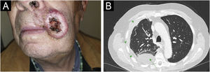 Patient Number 2. For Patient 2, a cSCC measuring 4.2 × 3.5 cm is observed at the left commissure of the lips (A). The axial CT scan (B) displays a mass consistent with pulmonary metastasis in the posterior segment of the lower right lobe (green arrows), accompanied by pleural effusion (green arrowheads) and associated laminar atelectasis.