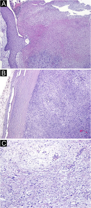 (A) Ulceration and necrosis with suppuration of the adjacent epidermis and dermis (Hematoxylin & eosin, ×40). (B) The lesion was well-delimited by a sclero-hyaline capsule (Hematoxylin & eosin, ×40). (C) Tumoral lesion consisting of ovoid to spindle-shaped cells, with areas of eosinophilic cytoplasm and indistinct boundaries (Antoni A pattern) alternating with more loose and hypocellular areas of cells with clear cytoplasm and well-defined boundaries (Antoni B pattern) (Hematoxylin & eosin, ×100).