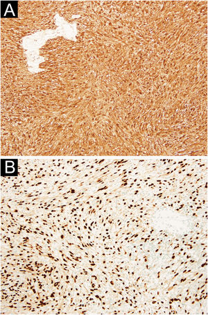 (A) Diffuse expression of S100 protein (×100). (B) Diffuse expression of SOX-10 (×100).