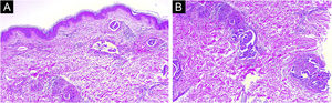 (A) Low power histological evaluation showing neoplastic cells infiltrating dermis. (Hematoxylin & eosin, 60×). (B) High-power histological evaluation showing clusters and nests of polymorphic cells with nuclear atypia and hyperchromatic nuclei forming ductal structures infiltrating blood vessels (Hematoxylin & eosin, 80×).