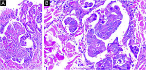 Clusters of atypical neoplastic cells arranged in nests and cords. Notably, the nuclei of these cells exhibit significant atypia in terms of size and shape, along with prominent nucleoli (Hematoxylin & eosin, 100× and 200×).