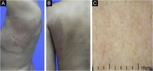 (A and B) The patient reported complete resolution of symptoms and showed remarkable improvement of the lesions one month after initiating a new therapy regimen with lapatinib 1 g/day. (C) Dermoscopy of the lesion after successful treatment. Structureless whitish areas with a pinkish hue.