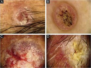 Features of keratinization dermoscopically in cutaneous squamous cell skin cancer: (A) Keratin crust/scale, (B) Central keratin plug, (C) White halos surrounding vessels, (D) White circles surrounding follicles.