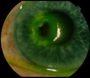 Perforación corneal del ojo izquierdo. Burbuja de aire en cámara anterior.