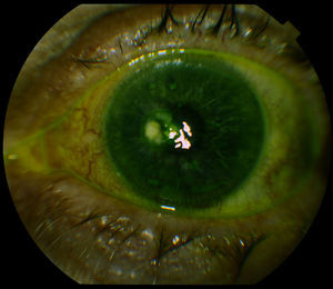 Perforación corneal cerrada totalmente. Imagen a los 3 meses de la intervención.