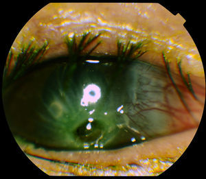 Perforación corneal inferior.