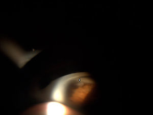 Gonioscopia mostrando un pequeño fragmento nuclear retenido en el ángulo inferior de la cámara anterior (flecha).
