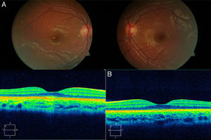 Fondo de ojo a color del primer caso de paciente de 4 años. (A) Lesión hipopigmentada ovalada macular temporal a fóvea en ojo derecho. Ojo izquierdo dentro de la normalidad. (B) Imagen de OCT que muestra normalidad de la estructura macular en ambos ojos.