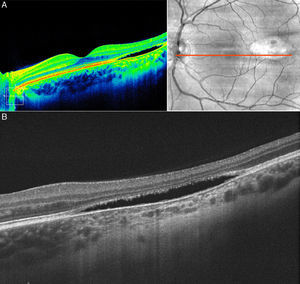 OCT. (A) OCT scan lineal de 9 mm con EDI a través de la lesión. Imagen de desprendimiento neurosensorial con atrofia del EPR y adelgazamiento de las capas retinianas con aumento de transmisión de la señal a través de la coroides. (B) OCT en escala de grises a mayor aumento que permite apreciar con más detalle el adelgazamiento de las distintas capas de la retina con una imagen de desprendimiento de retina neurosensorial y aumento de transmisión a través de la coroides.
