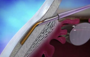 Detalle de cómo con la aguja clavada en el ángulo, se procede a la liberación del implante XEN45 al espacio subconjuntival.