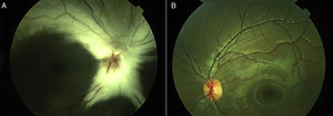 A) Mielinización de fibras nerviosas de la retina, abundantes en nervio óptico y ambas arcadas, respetando el área macular. Nótese el aspecto hipoplásico del nervio óptico. B) Fundoscopía indirecta del ojo izquierdo dentro de los límites normales.