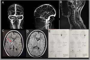 Se muestran las pruebas complementarias de la paciente 1 (CPG) A) Imágenes de angio-MRI sin alteraciones. B) MRI con gadolinio de la columna cervical sin alteraciones. C) Imagen de axial de MRI en secuencia FLAIR con gadolinio donde se observan lesiones hiperintensas en región capsulotalámica sugerentes de enfermedad desmielinizante. D) MRI realizada 6 meses tras la primera en la que no se observan lesiones. E) Campimetría Humphrey 24-2 dentro de la normalidad en ambos ojos (mínimo defecto paracentral OI).