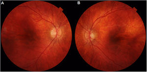 Retinografía color. Ausencia de alteraciones fundoscópicas significativas. Atrofia de epitelio pigmentario retiniano bilateral a nivel peripapilar, que se extiende ligeramente siguiendo trayecto de arcadas temporales (A y B). Disco óptico levemente oblicuo en el OI (B).