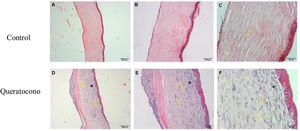 Alteraciones morfológicas después de la administración de colagenasa ii. Los cambios morfológicos de las córneas expuestas a colagenasa ii muestran cambios característicos de un proceso inflamatorio y de regeneración, además de pérdida de integridad en la capa de Bowman, en comparación con los controles. (A-C) Controles. (D-F) Queratocono. Ambos con los objetivos 5x, 10x y 20x, respectivamente (aumento 500, 1000 y 2000, barra de escala 200μm, 100μm y 50μm, respectivamente).