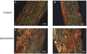 Cambio en las fibras de colágeno en el modelo animal de queratocono. La alteración en las fibras de colágeno de las córneas con colagenasa ii indican un proceso de regeneración del estroma corneal por acción de la colagenasa ii, principalmente la síntesis de colágeno tipo i. (A-B) Controles. (D-E) Queratocono. Ambos con los objetivos 10x (aumento 1000, barra de escala 100μm).