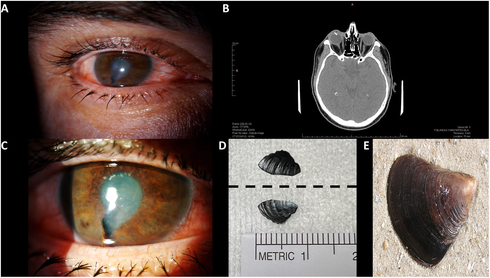 Un raro cuerpo extraño intraocular resultante de un accidente laboral ...