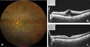 a. La retinografía revela la presencia de múltiples hemorragias puntiformes retinianas, tortuosidad vascular y ausencia de reflejo foveal. b. Tomografía de coherencia óptica macular (OCT) inicial que revela la presencia de edema macular cistoide. c. OCT 48h después de la inyección con presencia de puntos hiperreflectivos en la interfase vítrea y resolución del edema.