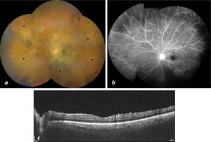 a. Retinografía de campo amplio realizada tras la administración de la 2.a dosis de bevacizumab, mostrando envainamiento vascular generalizado (flechas negras). b. Fases tardías de la angiografía con fluoresceína (FA) mostrando ligera filtración perivascular en áreas de engrosamiento vascular, principalmente en la retina nasal. c. Tomografía de coherencia óptica mostrando remisión del edema macular.