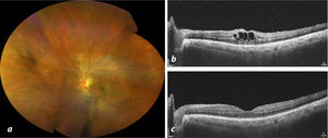 a. Retinografía de campo amplio mostrando resolución del engrosamiento vascular tras la administración de esteroides perioculares y fármacos antiinflamatorios tópicos no esteroides. b. Recurrencia del edema macular cistoide (EMC), observada por tomografía de coherencia óptica. c. Resolución del EMC tras la administración de una dosis de aflibercept tras 7 semanas de seguimiento.