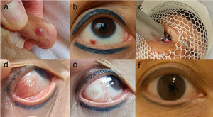 a) Lesión rojiza (<5mm) en el quinto dedo del pie izquierdo. b) Masa vascular rojiza e indolora (<5mm) en conjuntiva. c) Irradiación mediante radioterapia superficial (Intrabeam®) con aplicador plano de 1cm de diámetro, inmovilización con máscara y separador palpebral. d) Conjuntivitis aguda una semana tras tratamiento. e) Resolución clínica al mes. f) Ausencia de recurrencia tras 5 años de seguimiento.