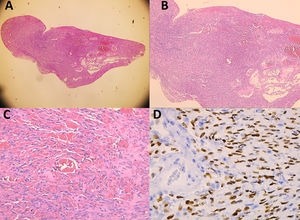 A) Vista panorámica del tumor estromal conjuntival con patrón nodular y áreas raras de vasos ectásicos. H-E, objetivo 2x (20x). B) Células tumorales fusiformes atípicas con patrón sarcomatoide y congestión vascular. H-E, objetivo 5x (50x). C) Canales vasculares en hendidura y extravasación de eritrocitos entre células tumorales. H-E, objetivo 20x (200x). D) Inmunohistoquímica positiva para VHH-8 con patrón nuclear. H-E objetivo 40x (400x).