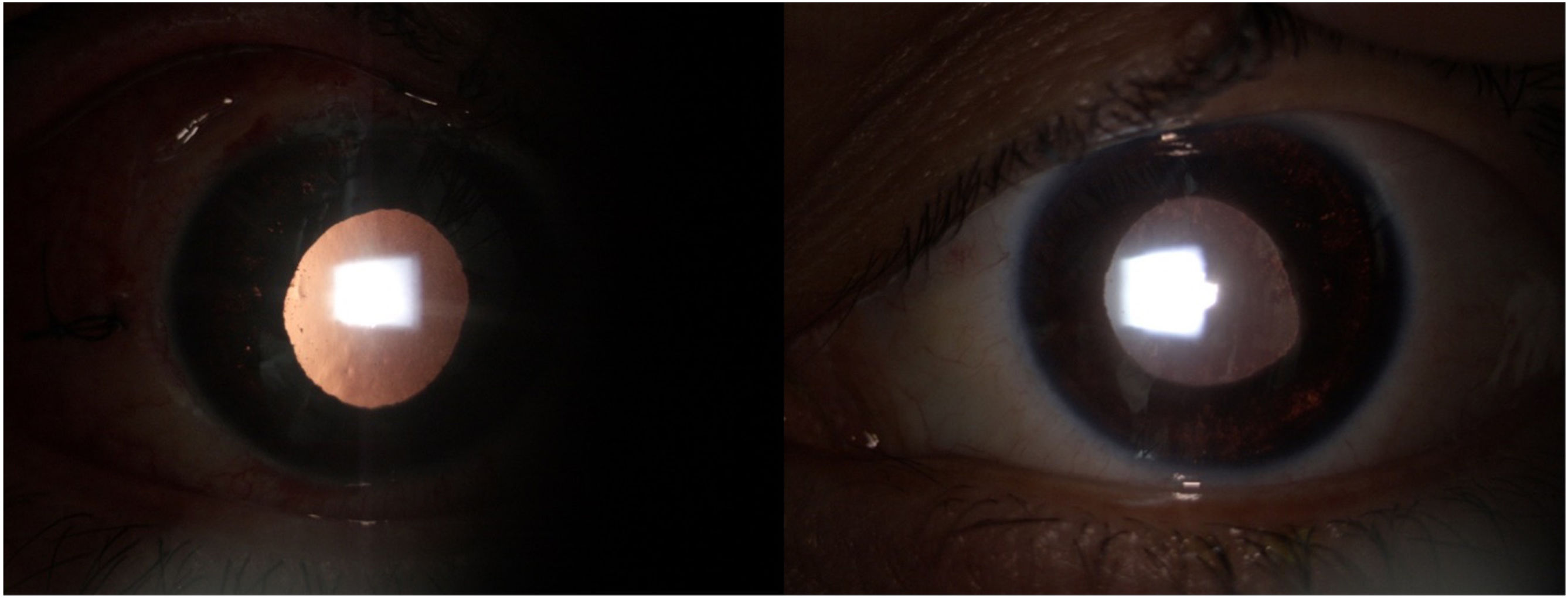 Discoria Transiluminación aguda bilateral del iris: descripción de 2 casos ...